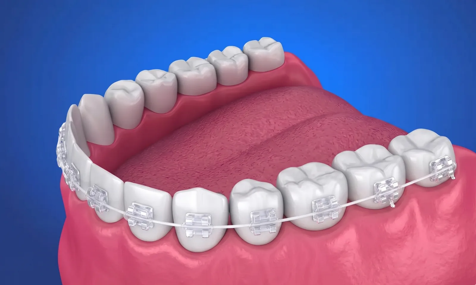 Frenos e Invisalign