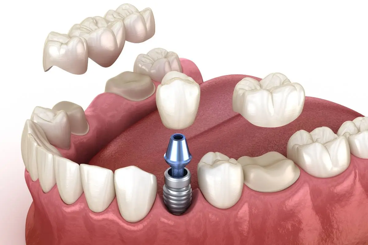 Implantes dentales