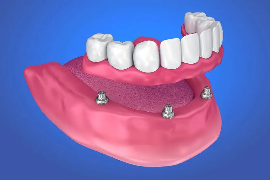 Dentaduras y parciales